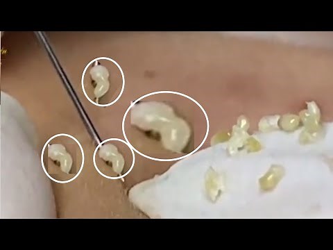 Removal whiteheads and blackheads (262) Loan Nguyen