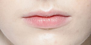 How to Heal Cracked Lip Corners Fast, According to Dermatologists