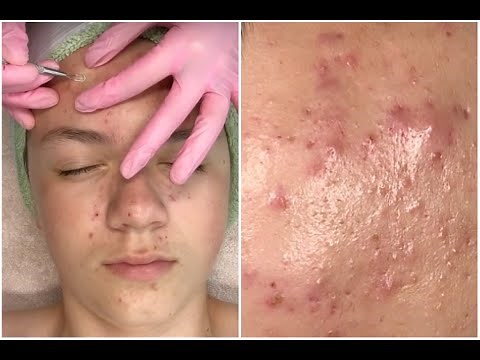 Acne Clarifying Facial + HD Pimple Popping | {Super Informative} | Jadeywadey180