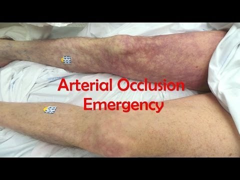 Acute, Complete Occlusion of the Leg Arteries