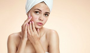 5 reasons your acne keeps coming back
