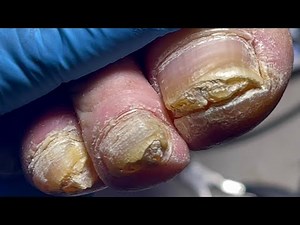 Thick nails, every toenail infected with onychomycosis【Pedicure Master Lin Jun】
