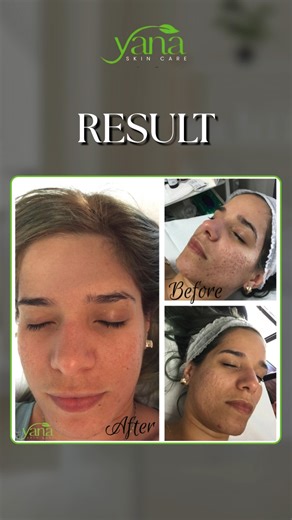 Quick Breakdown – How RF Microneedling Works How does RF microneedling work? Tiny microchannels + radiofrequency energy = fresh collagen and smoother skin. ✨ The before and after results speak for themselves. Curious and searching for “RF microneedling near me”? Book your consult today and learn how it can transform your skin. #rfmicroneedlingtreatment #microneedlingresults #freshcollagen #smootherskin #collagenboostingtreatment #cosmetictreatments | Yana Skin Care | Facebook