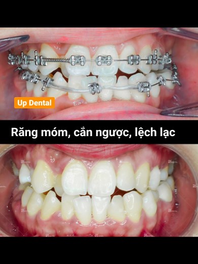 Metal Braces for Underbite and Misaligned Teeth: Detailed Treatment View