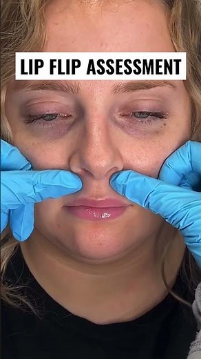 How a Botox lip flip works 💉 #reels #lipflip #botox #botoxinjections