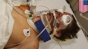 Sparkler bomb: Texas teen Rowdy Radford loses leg, fingers, and eyesight in accident - TomoNews