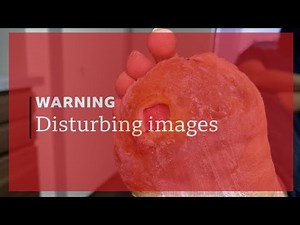 DIABETIC ULCER EXAMINATION - STAY OFF THE FOOT!!!!