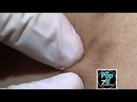 29 juicy pops in 7 minutes. Blackhead extractions. Whitehead extractions. Cyst pop. MrPopZit.