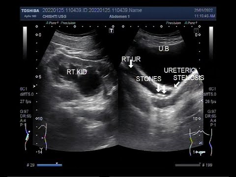 Ureterovesical junction (UVJ) obstruction, with two ureteric stones.