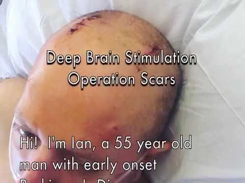 Deep Brain Stimulation (DBS) Operation Scars