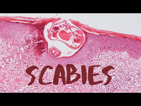 What is Scabies? - Pathology mini tutorial