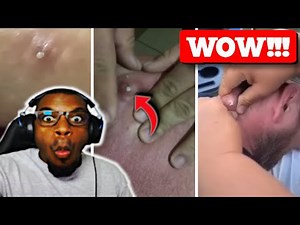 Pimple Popping COMPILATION Like You've NEVER SEEN