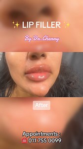 6.8K views · 13 reactions | CHERRY LIPS 﫧✨ #lips #juicylips #plumplips #lipfiller #filler #dermalfiller #srilanka #colombo | Dr. Sarah Fazy / Dr. Cherry | Facebook