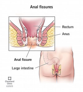 Anal Fissure
