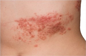 Postherpetic Neuralgia - Sound Pain Alliance Causes & Treatments