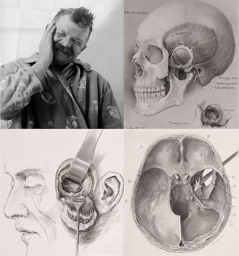 Microvascular Decompression for Trigeminal Neuralgia | Cohen Collection | Volumes | The Neurosurgical Atlas