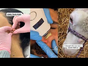 Popping huge blackheads and Pimple Popping - Best Pimple Popping Videos 304