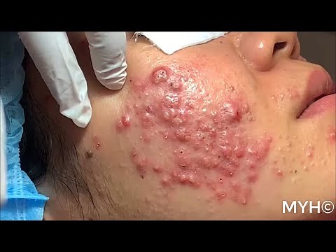 Cystic Pustules Acne Extractions EP.14 (No Clickbait)