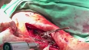 Humerus Reconstruction