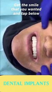 664K views · 100 reactions |  혿홤 홉홤황 홋홖홮 $2,000 Per Implant: Full mouth or single tooth procedures (pricing on the next page)  | Body Hacks | Facebook