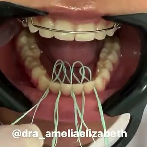 Placing a lingual retainer 醴 #ortho #hack #dentistry #smile . . By @dra_ameliaelizabeth | Dentistry blog | Facebook