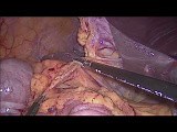 Hemicolectomía derecha laparoscópica con anastomosis intracorpórea • Vídeo • MEDtube.es