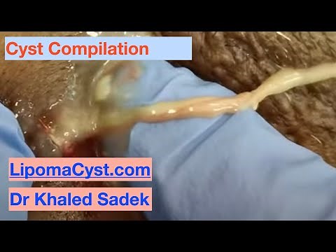 Cyst Pop Compilation. Dr Khaled Sadek. LipomaCyst.com