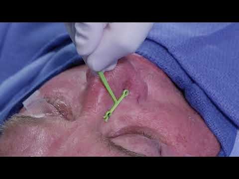 Demonstration of the Latera Implant for Nasal Valve Collapse (Warning: Graphic Surgical Content)