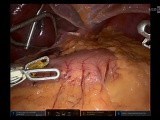 Distal Pancreatectomy with Splenectomy • Video • MEDtube.net