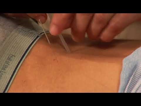 Acupuncture as Treatment for Back Pain