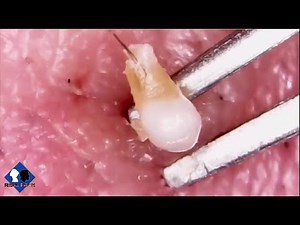 Blackheads Removal Close up (part13)