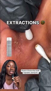 #sebaceousfilament #sebaceousfilaments #sebaceousremoval #theordinaryglycolicacid