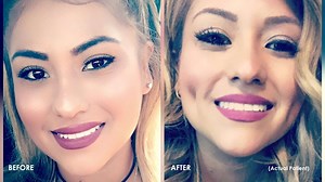 Is Dimpleplasty Worth It? The Timeless Dimple Definitely Is!