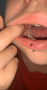 fun little abscess popped with salt water (hands are clean, and applying no pressure)