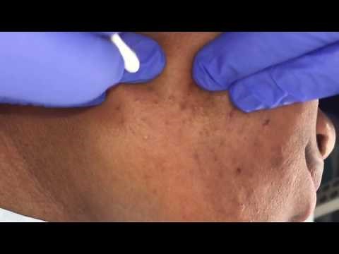 Blackhead Breakout