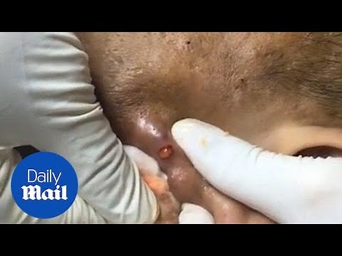 Stomach-churning moment enormous pimple popped