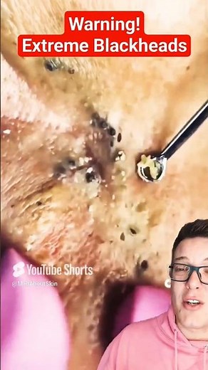 Crazy Extreme BLACKHEAD REMOVAL - Best Blackheads 2025