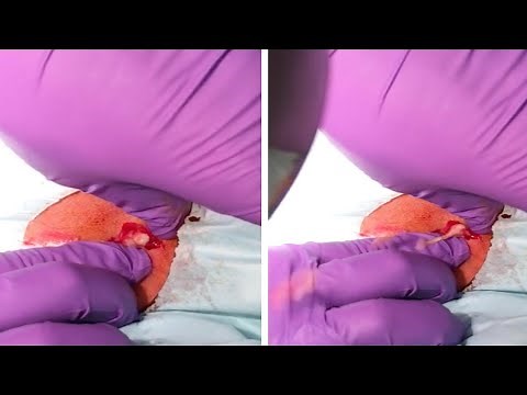 Huge Cyst Explosion