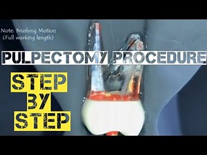 #pulpectomyprocedure #pulpectomy\n#rotaryendodontics pulpectomy procedure step by step||kedo square
