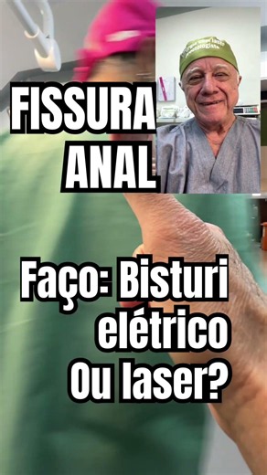 Fissura anal: Trato bisturi elétrico ou laser gás carbônico?