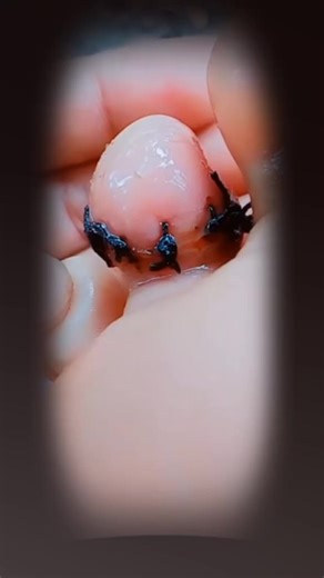 Effective Blackhead Extraction Techniques Explained