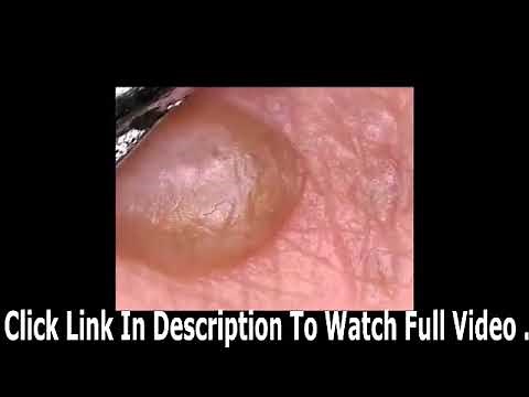 Top cinq boutons et points noirs! Sous le microscope