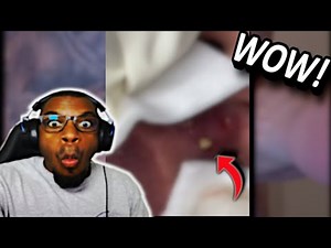 MASSIVE Cyst Popping Moments That Will SHOCK You!