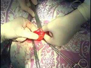 Right Sided Lichtenstein Hernioplasty For Indirect Inguinal Hernia