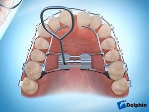 The PALATAL EXPANDER is a device in the field of orthodontics which is used to widen the upper jaw (maxilla) so that the bottom and upper teeth will fit together better. For more information schedule an appointmet with our doctors. It is Free #freeconsultation #noinsurance #inboxfordetails #coolbraces #braces #braceslove #happypatient #noinsurance #miamidentist #orthodontics #smile #teeth #freeconsult #inboxfordetails #selfligatingbraces #porcelainbraces #downtown #miamibraces #dentist #florida 