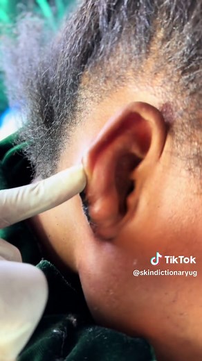 In keloid treatments Laser treatment offers a less invasive keloid removal option with success in improving skin color and scar tissue appearance. #keloid #keloidremoval #keloids #skindictionary