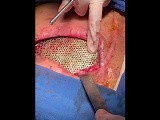 Another Case of Chest Wall Reconstruction (1) • Video • MEDtube.net