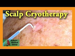 Scalp Cryotherapy | Auburn Medical Group