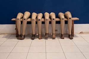 Surgeon fined $3,000 for amputating wrong leg