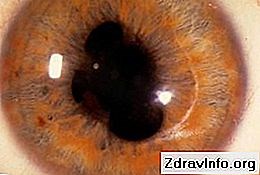 İridosiklit nedir? Hastalık nasıl tedavi edilir? 👃👃 Portal Sinüs Ve Diğerleri. - 2025
